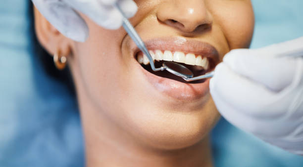 Best Emergency Wisdom Tooth Extraction in Rio Bravo, TX